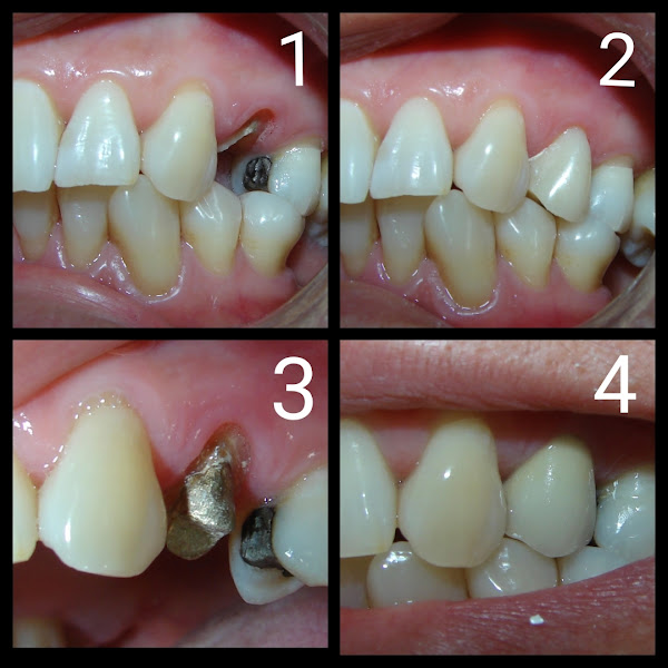Foto 3 de Prótese Dentária - Dr Igor Pimenta