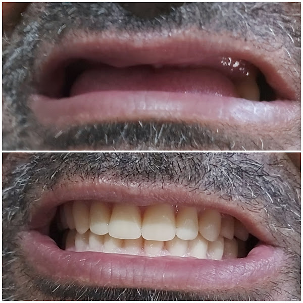 Foto 3 de Próteses Dentária,Castelo Branco!