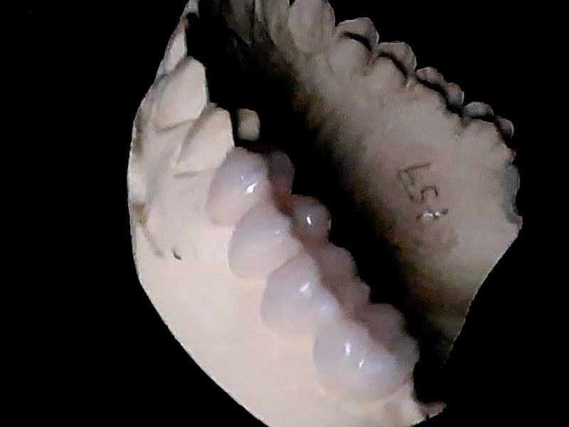 Foto 6 de Protético: Conserto Prótese e Dentadura na Hora.