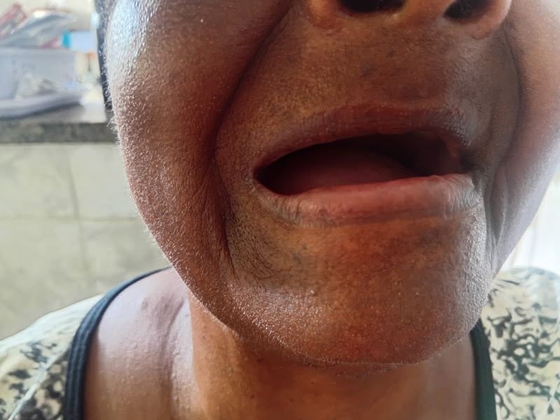 Foto 3 de Protético em Casa - Atendemos Urgências! 20 anos de Experiência! Protese Flexível, Dentadura, Roach, Provisória.