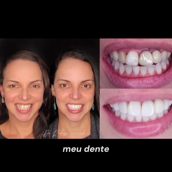 Foto 3 de PuroRiso Odontologia | Dr. Rodrigo Eduardo – Reabilitação Oral