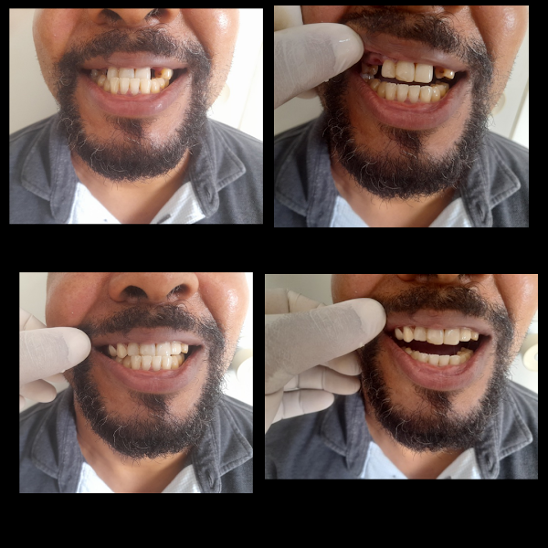 Foto 3 de RAFA CHAGAS PRÓTESE DENTÁRIA