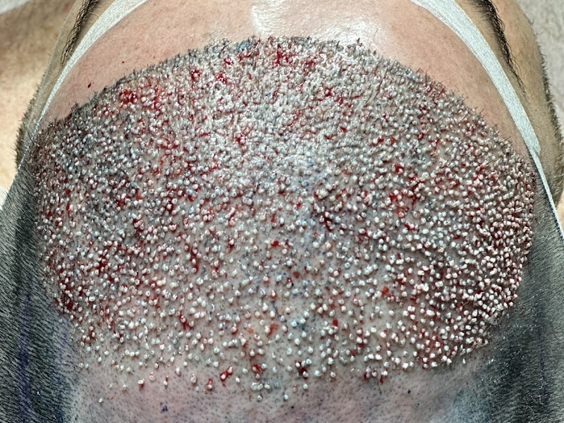 Foto de Refio - Clínica de Implante Capilar