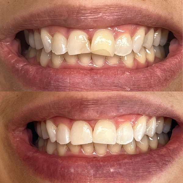 Foto 2 de Revittale Odontologia | Ortodontista | Invisalign | Implantes | Tratamento do ronco e apneia do sono | Feira de Santana Ba