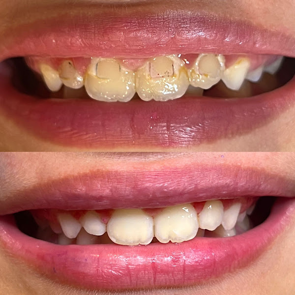 Foto 3 de Revittale Odontologia | Ortodontista | Invisalign | Implantes | Tratamento do ronco e apneia do sono | Feira de Santana Ba