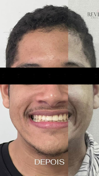Foto 4 de Revittale Odontologia | Ortodontista | Invisalign | Implantes | Tratamento do ronco e apneia do sono | Feira de Santana Ba