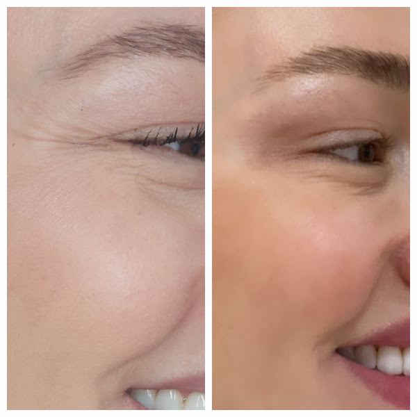 Foto 3 de Rosângela Paz – Botox, Pele & Harmonização Facial | Praia Grande