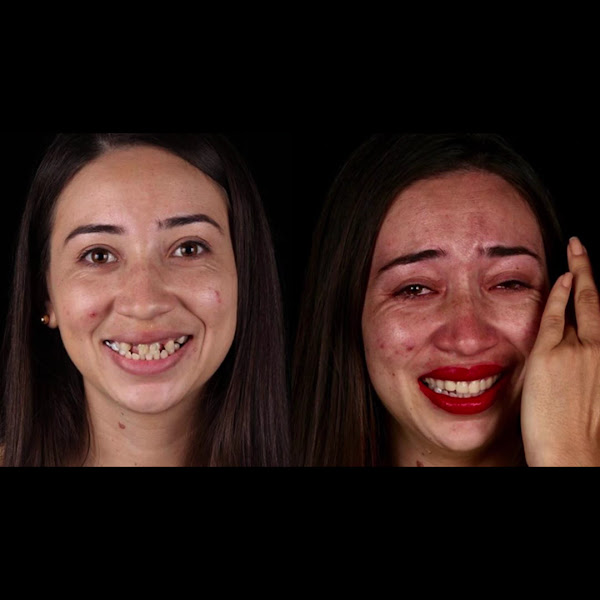 Foto 3 de Sávio Junio Estética Dental | Implante Dentário Clareamento Dentário Facetas e Lentes| Dentista em Marabá