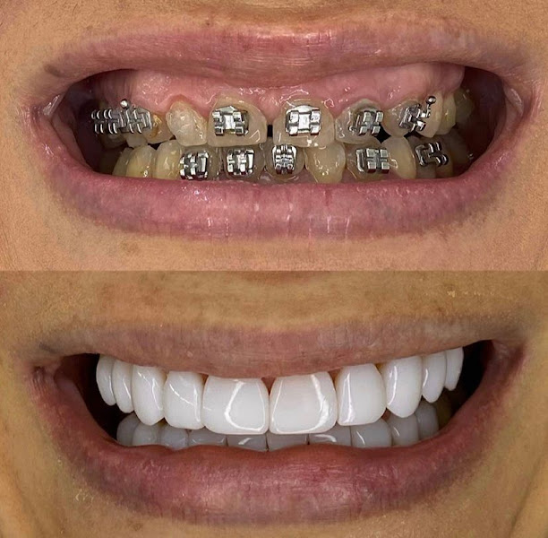 Foto 2 de Sbv Lentes de Resina Liberdade