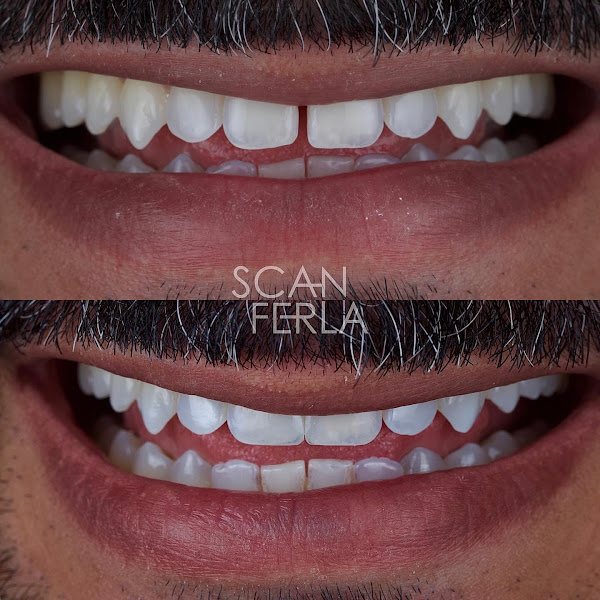Foto 3 de Scanferla Odontologia - Dentista | Prótese | implantes | Facetas | Alinhador invisível | Botafogo