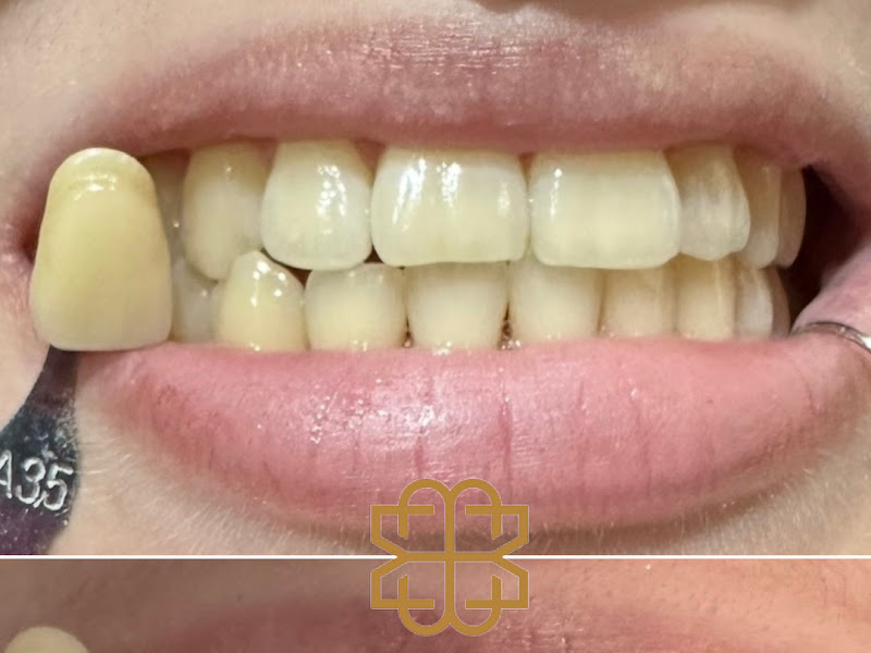 Foto 6 de Sempre Sorrindo Implantes Dentários | Facetas de Porcelana