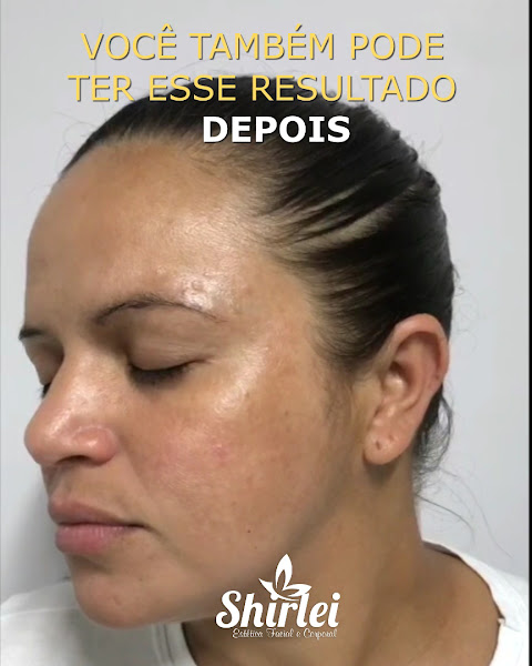 Foto 3 de Shirlei Estética Facial e Corporal