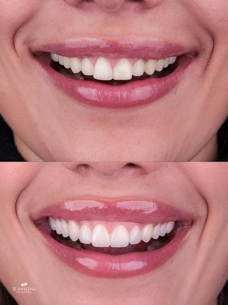 Foto 3 de Simioni Odontologia - Implante e Lente de Contato Dental