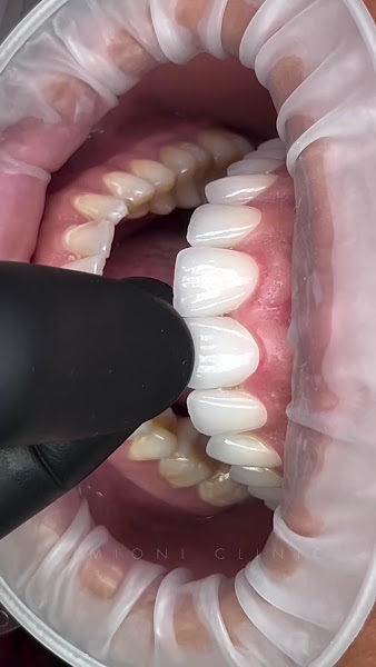 Foto 4 de Simioni Odontologia - Implante e Lente de Contato Dental