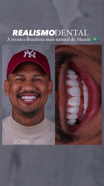 Foto 3 de Sorri lentes