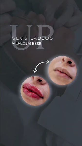 Foto 3 de Sorria Beauty | Harmonização Facial | Vila Medeiros