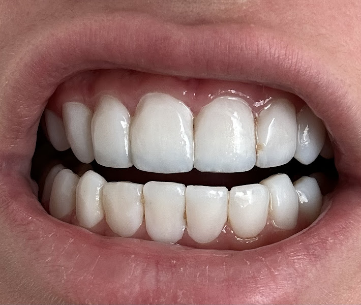 Foto 3 de Sorriadente Odontologia | Facetas | Botox | Ortodontia | Implantes