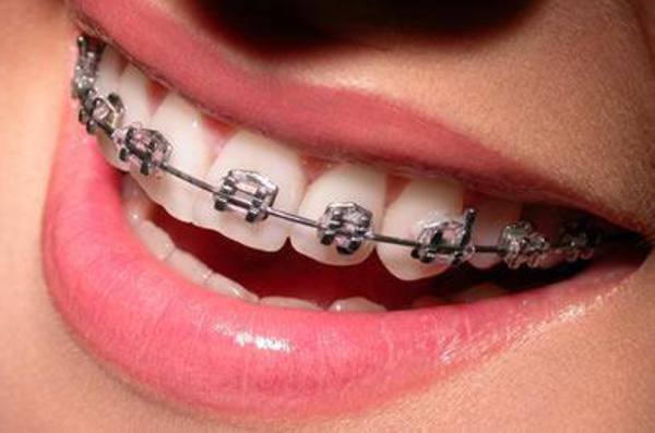 Foto 3 de Sorridents Igapó: Dentista, Clínica Odontológica, Clareamento em Natal