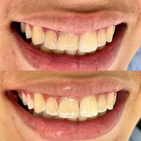 Foto 4 de Sorridents Mogi Bras Cubas | Implantes dentários | Prótese protocolo | Clínica Odontológica em Mogi Das Cruzes
