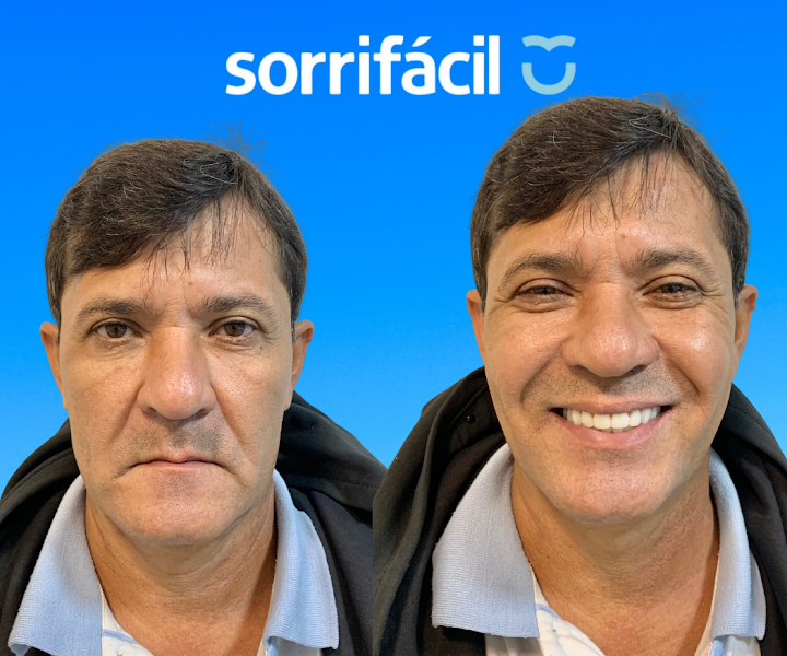 Foto 2 de Sorrifácil Campina Grande | Implantes Dentários, Prótese Protocolo, Reabilitação Oral e Lentes de Contato