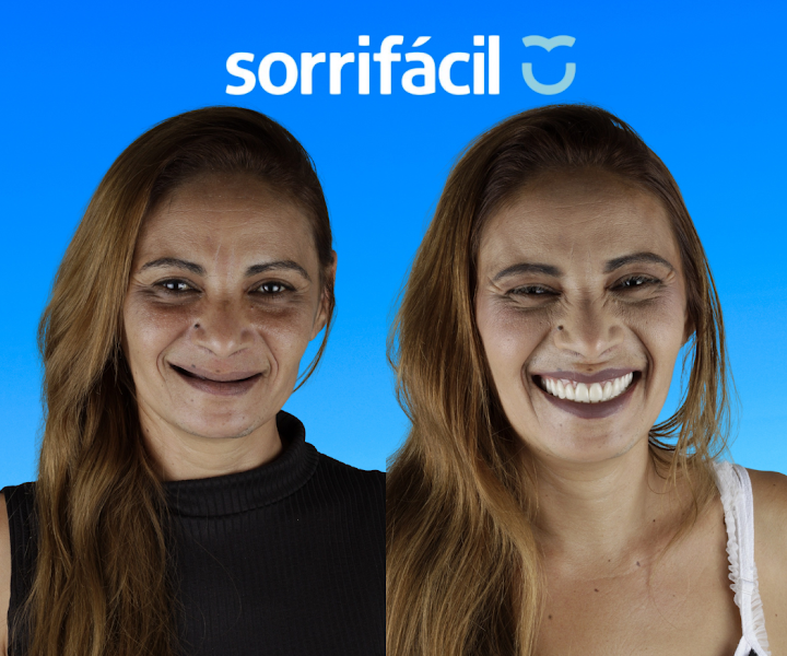 Foto 2 de Sorrifácil Caruaru | Implantes Dentários, Prótese Protocolo, Reabilitação Oral e Lentes de Contato