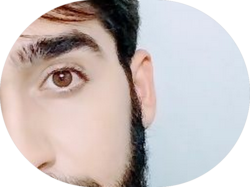 Foto 6 de Sorrifácil Caruaru | Implantes Dentários, Prótese Protocolo, Reabilitação Oral e Lentes de Contato