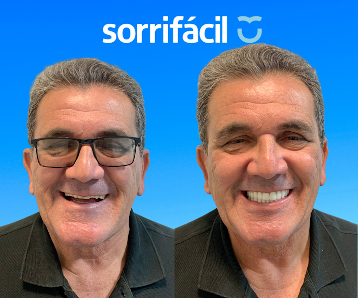 Foto 2 de Sorrifácil Jóquei (Implantes, Prótese Protocolo, Reabilitação Oral e Lentes de Contato)