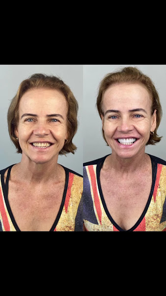 Foto 4 de Sorrifácil Maceió | Implantes, Prótese Protocolo, Reabilitação Oral e Lentes de Contato
