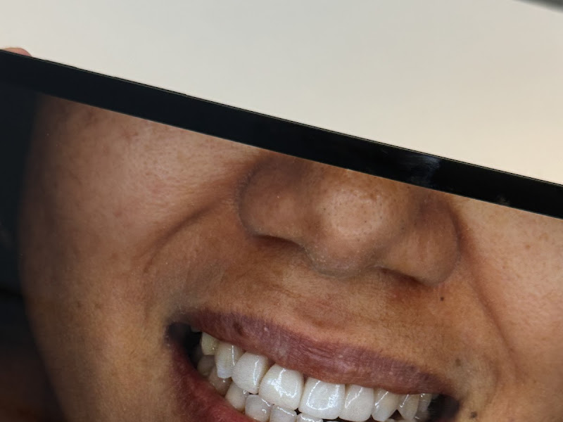 Foto 9 de Sorrifácil Porto Velho | Implantes Dentários, Prótese Protocolo, Reabilitação Oral e Lentes de Contato