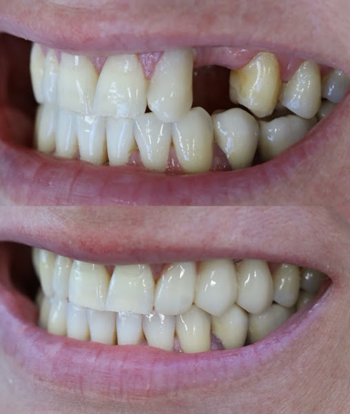 Foto 3 de Sorriluz Uvaranas | Implantes dentários e aparelho invisível