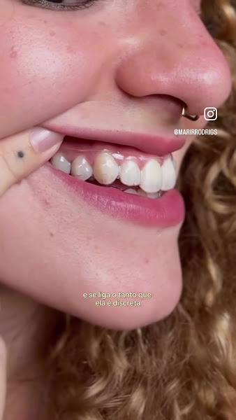 Foto 3 de SouSmile | Aparelho Invisível | Belo Horizonte