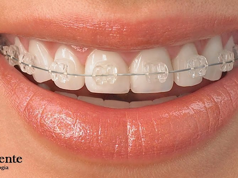 Foto 9 de Star Sorrindo Piracicaba | Clínico Geral | Implante Dentário | Próteses Dentárias