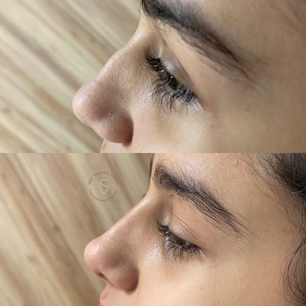 Foto 3 de SV Clinic/Dra Silmara Varela - Harmonização Facial e Glútea