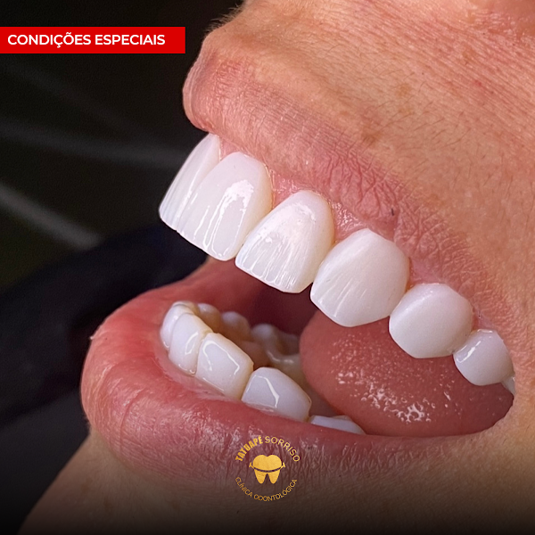 Foto 3 de Tatuapé Sorriso Clínica Odontológica, Referência Lentes de Resina/Porcelana, Dentista Tatuapé