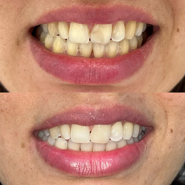 Foto 3 de Tavolazzi Odontologia - Aparelho Invisível SouSmile