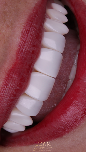 Foto 2 de Team Dr. Alan - Odontologia Estética - Preenchimento Labial, Lentes de Resina, Harmonizacao Facial