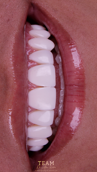 Foto 3 de Team Dr. Alan - Odontologia Estética - Preenchimento Labial, Lentes de Resina, Harmonizacao Facial