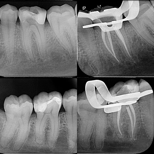 Foto 3 de Tratamento de canal - Leonardo Schamann - Doutor Canal