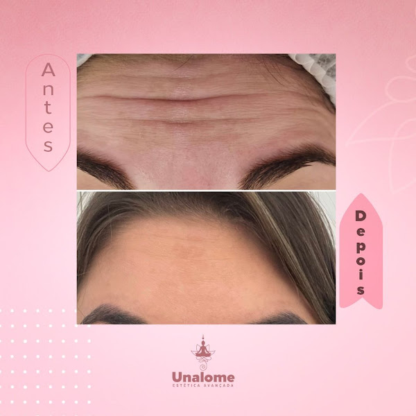 Foto 3 de Unalome Estética Avançada em Tangará da Serra - Estética facial e corporal - Botox - Criolipólise - Harmonização facial