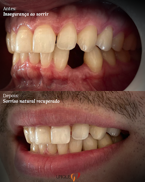 Foto 2 de Unique Aligner