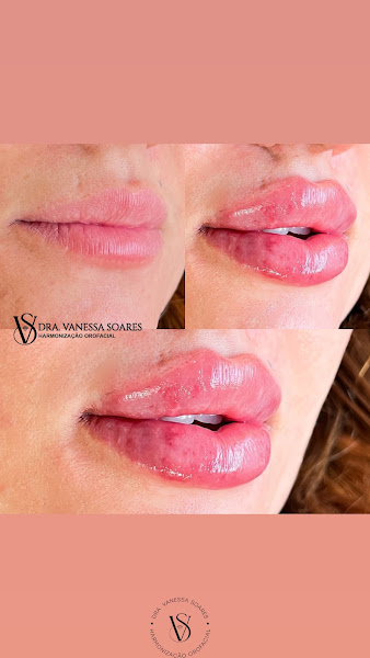 Foto 2 de Vanessa Soares Harmonização orofacial BH Belo Horizonte