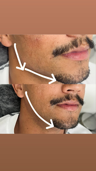 Foto 3 de Vanessa Soares Harmonização orofacial BH Belo Horizonte