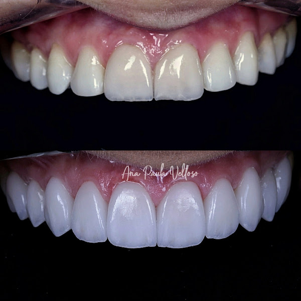 Foto 3 de Velloso Odontologia - Facetas em Vitória