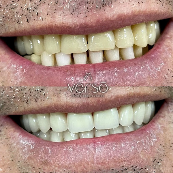 Foto 2 de Verso Odontologia | Implantes | Prótese Protocolo | Estética
