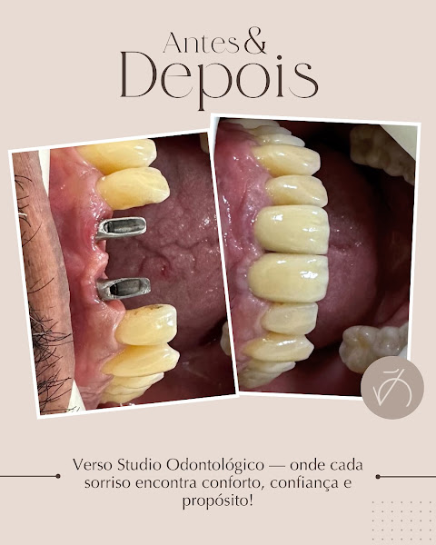 Foto 3 de Verso Odontologia | Implantes | Prótese Protocolo | Estética