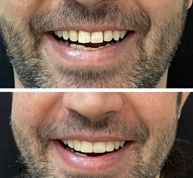 Foto 2 de Vicentiné Clinic- Odontologia Maringá | Botox | Preenchimento Labial