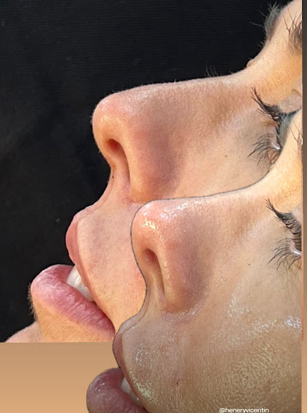 Foto 3 de Vicentiné Clinic- Odontologia Maringá | Botox | Preenchimento Labial