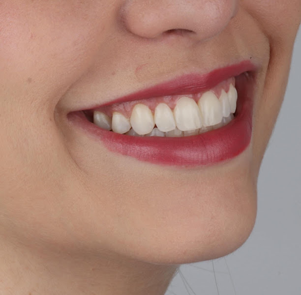 Foto 2 de Vilani Ortodontia | Ortodontia Especializada | Invisalign | Aparelho Ortodôntico | Clareamento Dental | Limpeza Dental