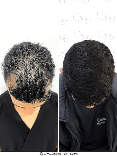Foto 3 de Vinci Hair Clinic
