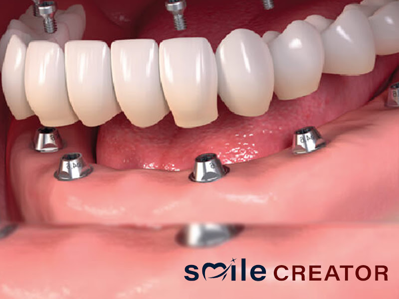 Foto 7 de Vivace Odontologia em Goiânia l Implantes Dentários l Próteses l Facetas